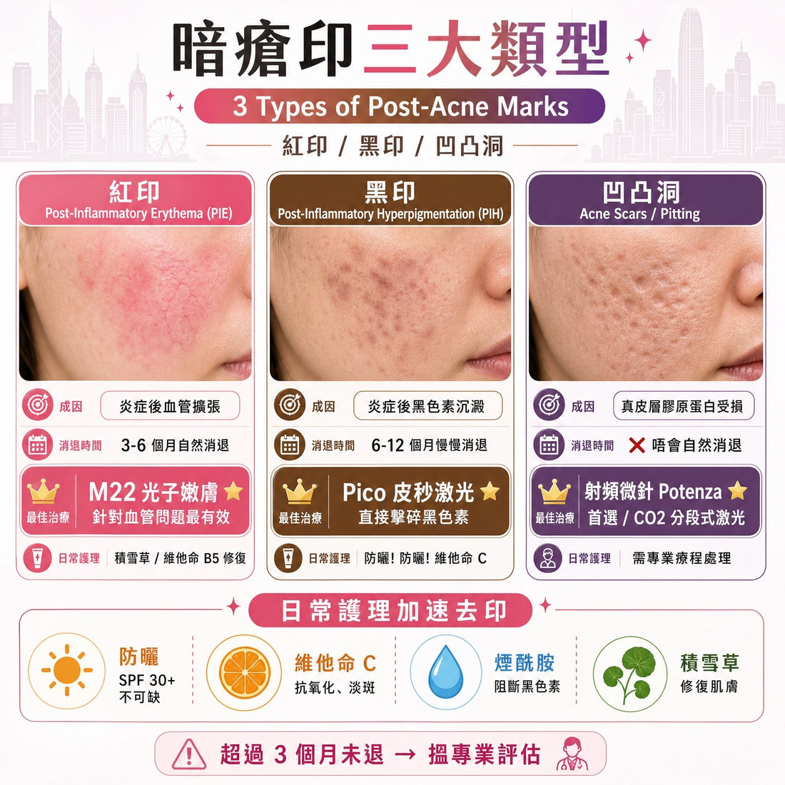 暗瘡印自救手冊：紅印、黑印、凹凸洞點算好？
